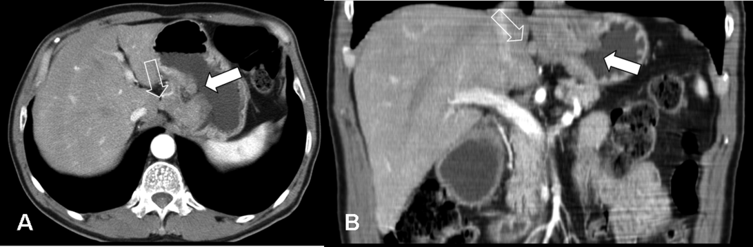 gastric cancer on ct