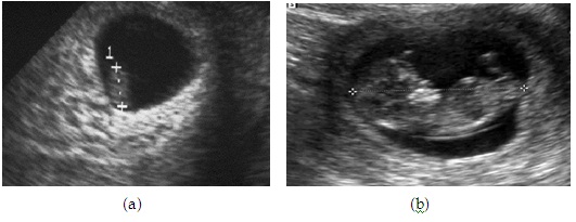how accurate is gestational age ultrasound