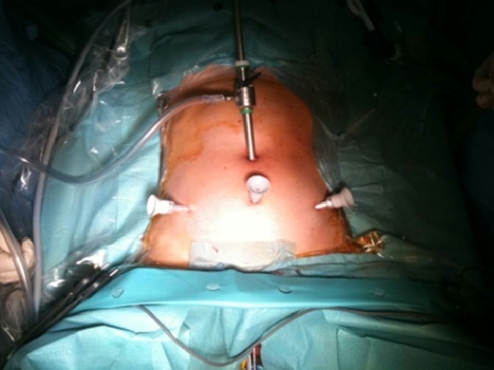 laparoscopic hysterectomy procedure