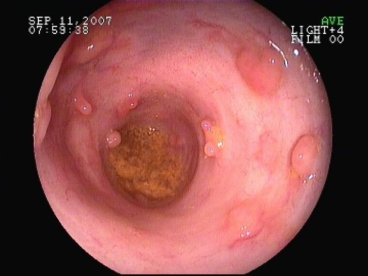 Endoscopic Approach in Ulcerative Colitis | IntechOpen