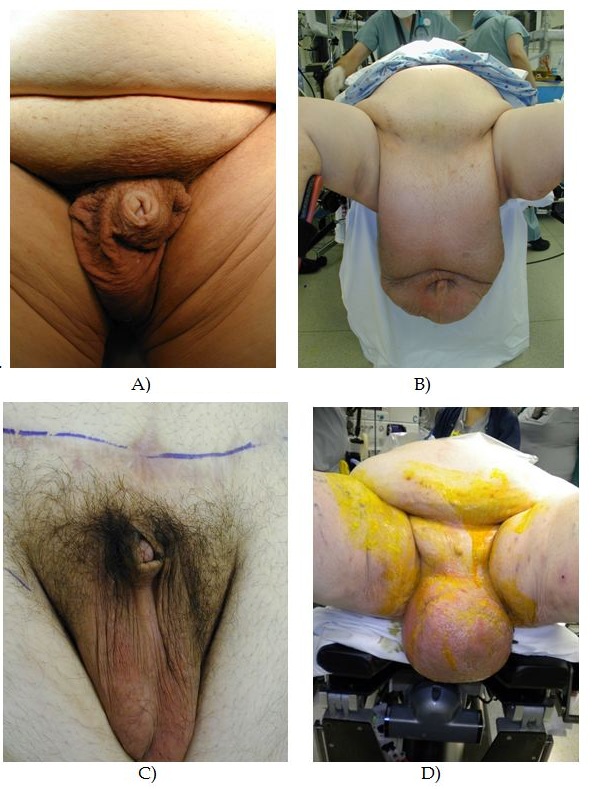 Cocks Fat Circumcised Men