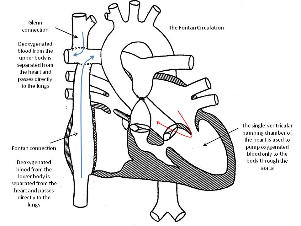 Heart single chamber Single Ventricle