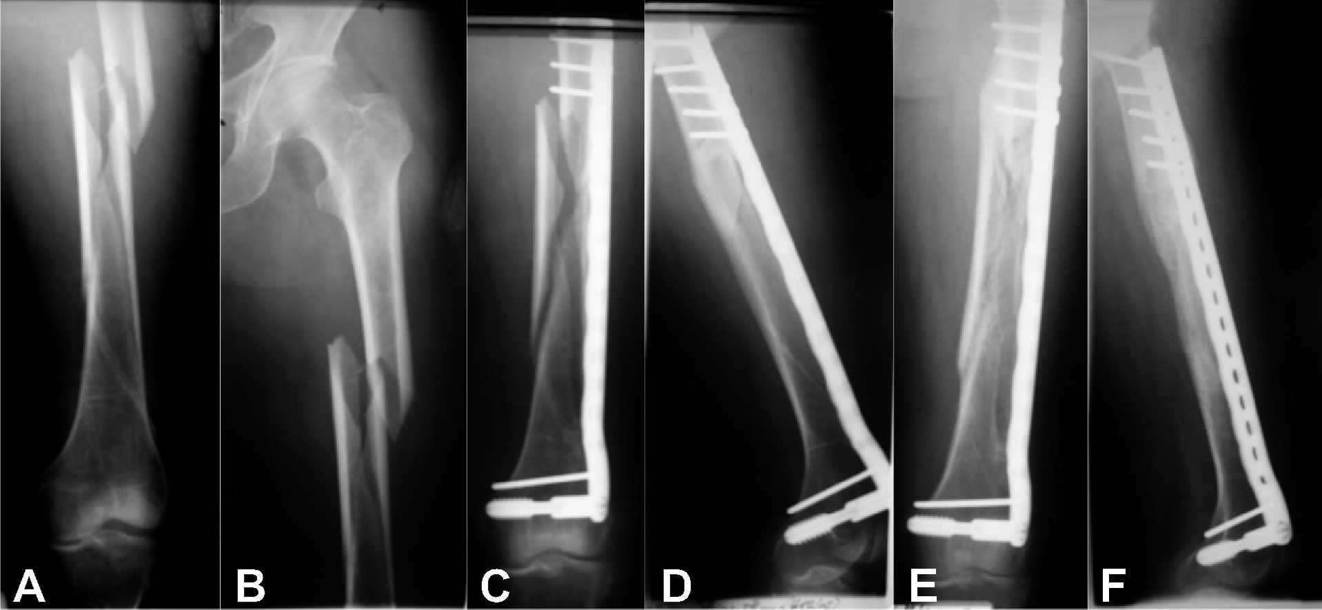 Minimally Invasive Plate Osteosynthesis (MIPO) in Long Bone Fractures –  Biomechanics – Design – Clinical Results | IntechOpen