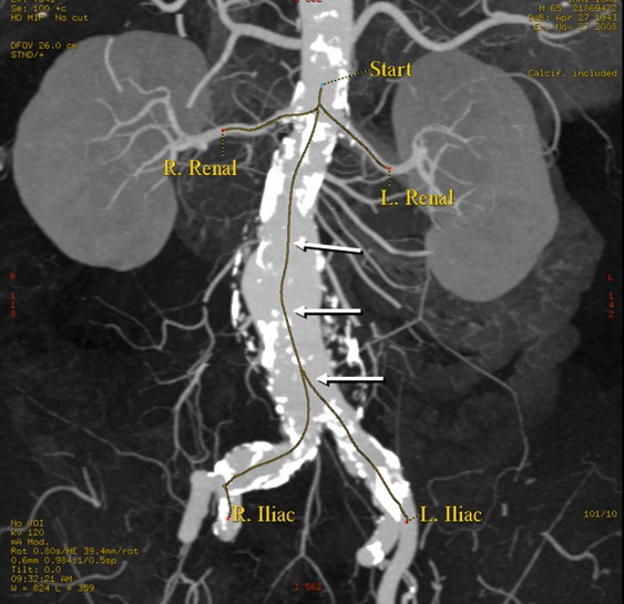 Abdominal Aortic Aneurysm In Different Races Epidemiologic