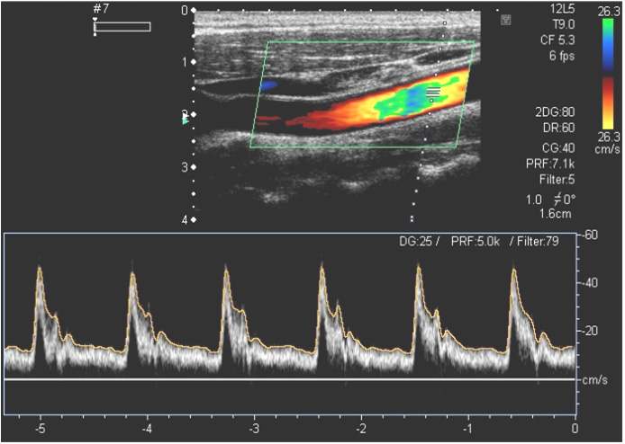 Doppler Ultrasound Color Chart