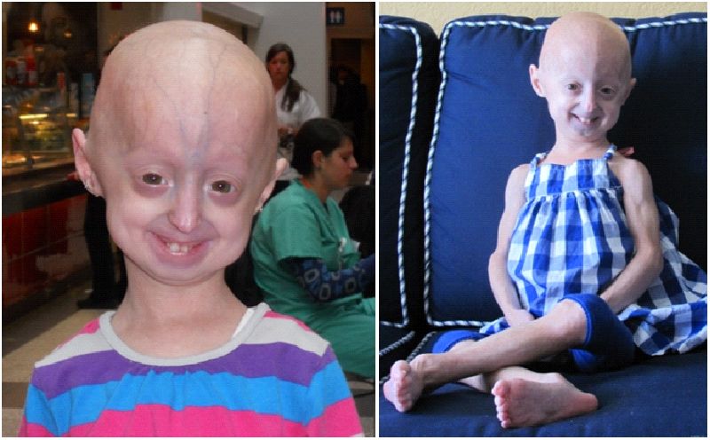 Neonatal progeria