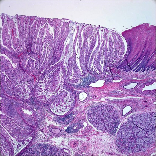 gastric cancer histological types