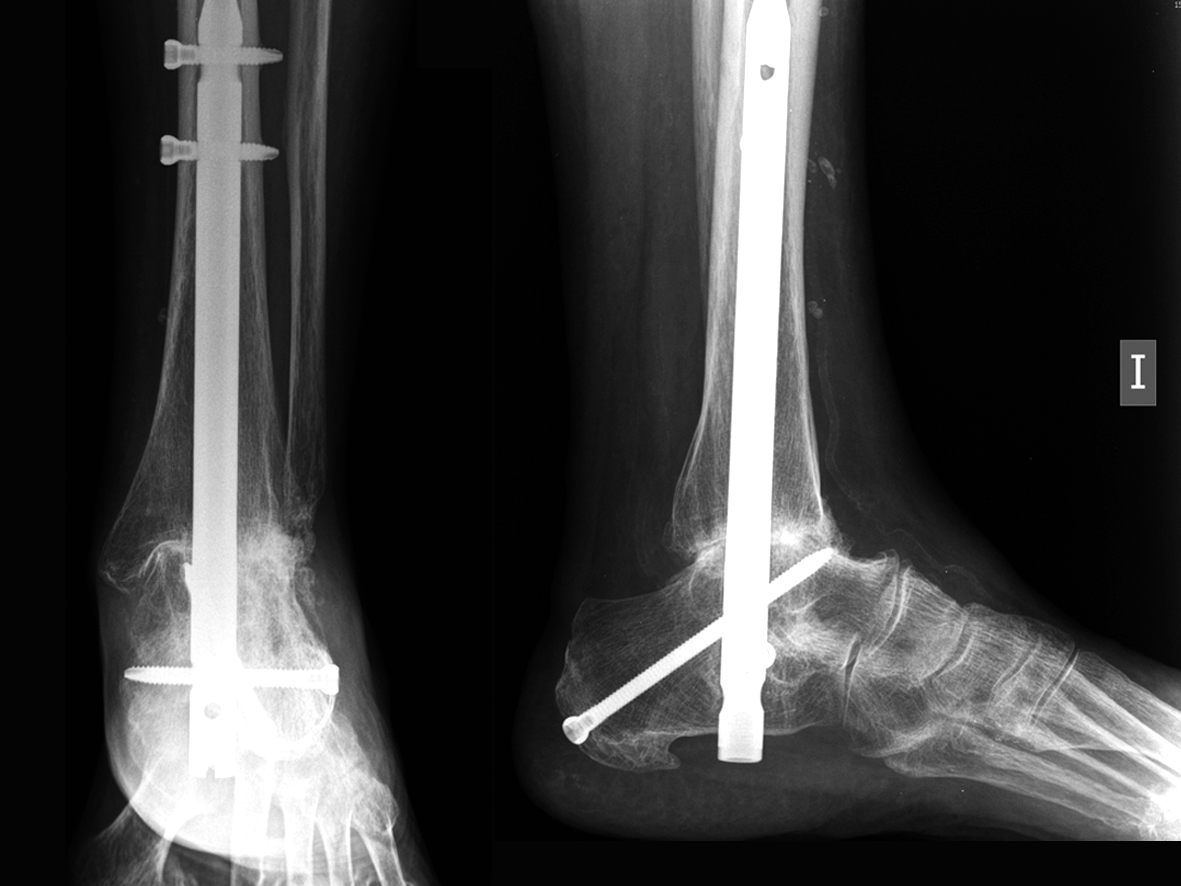 Arthroscopic Ankle and Subtalar Arthrodesis – Indications and Surgical  Technique | IntechOpen