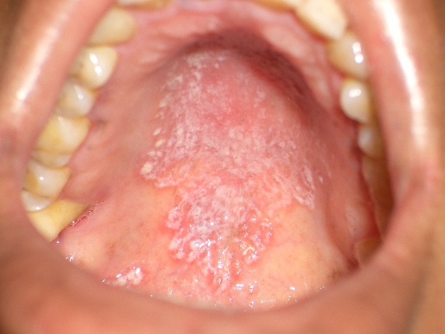 Проявление ВИЧ-инфекции в полости рта. Язык при ВИЧ-инфекции: фото