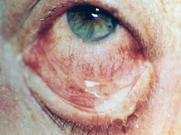 Conjunctivitis meaning