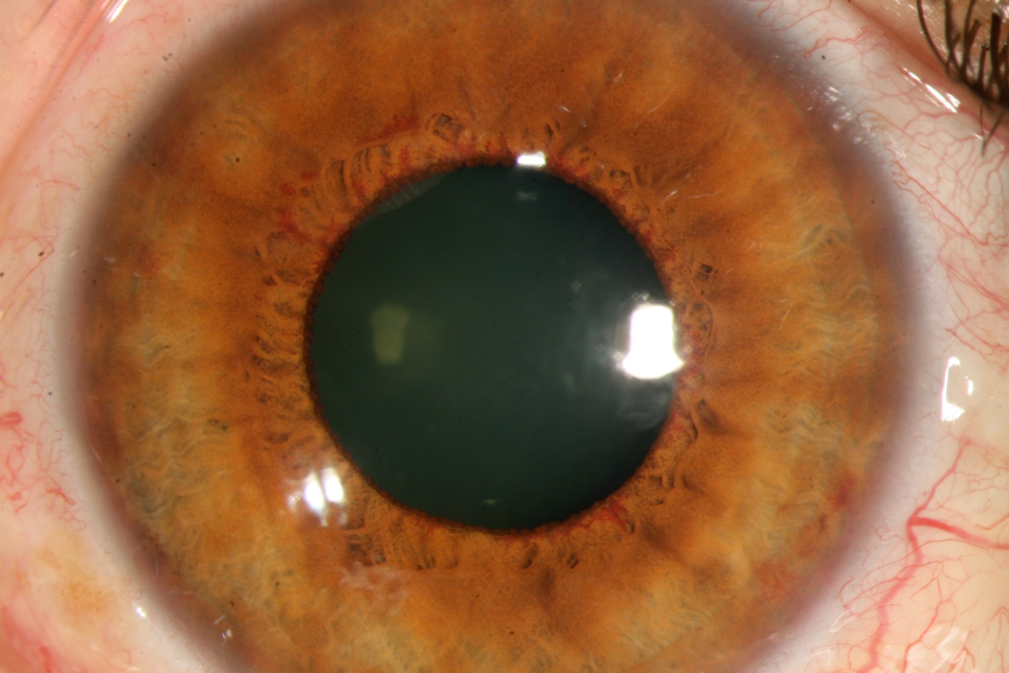 Neovascular Glaucoma Intechopen