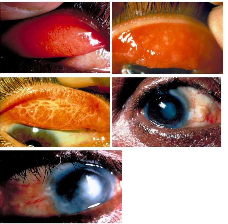 Trachoma And Inclusion Conjunctivitis Intechopen