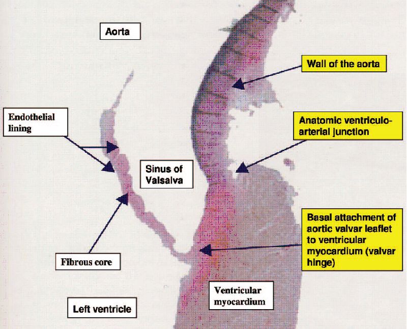 Anatomy And Function Of Normal Aortic Valvular Complex Intechopen