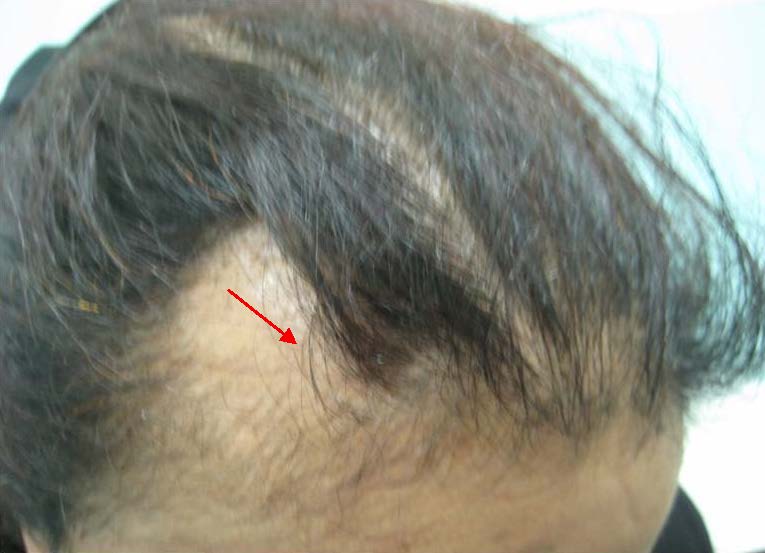 Scalp Biopsy and Diagnosis of Common Hair Loss Problems | IntechOpen