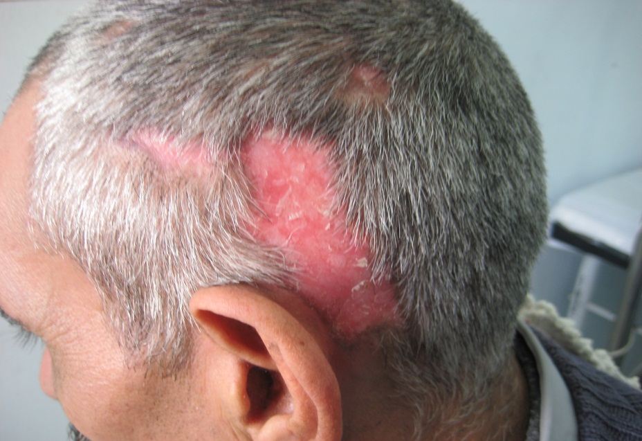 Scalp Biopsy And Diagnosis Of Common Hair Loss Problems Intechopen
