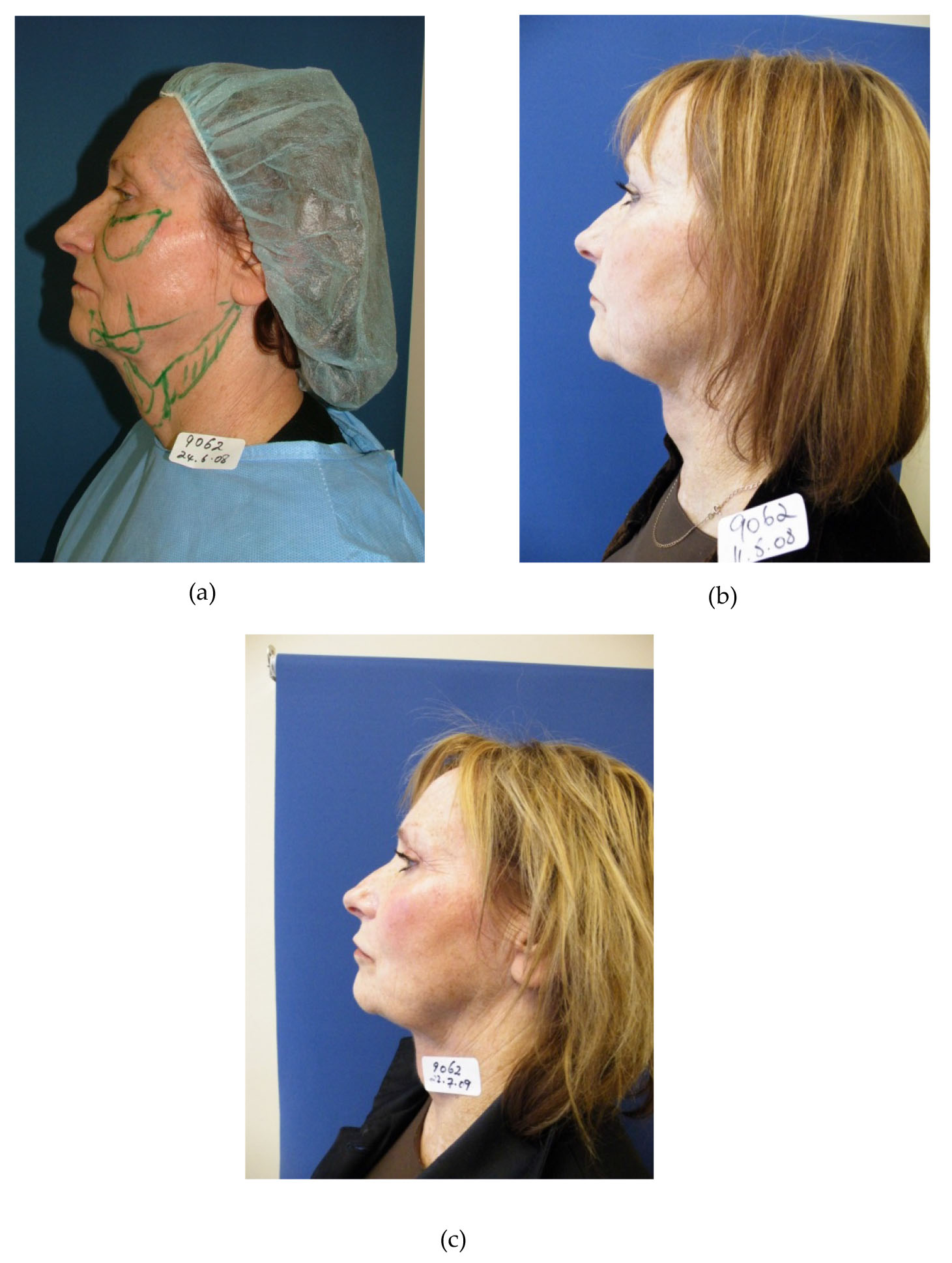 Suture Lifting and Liposculpture Integration in the Creation of Facial