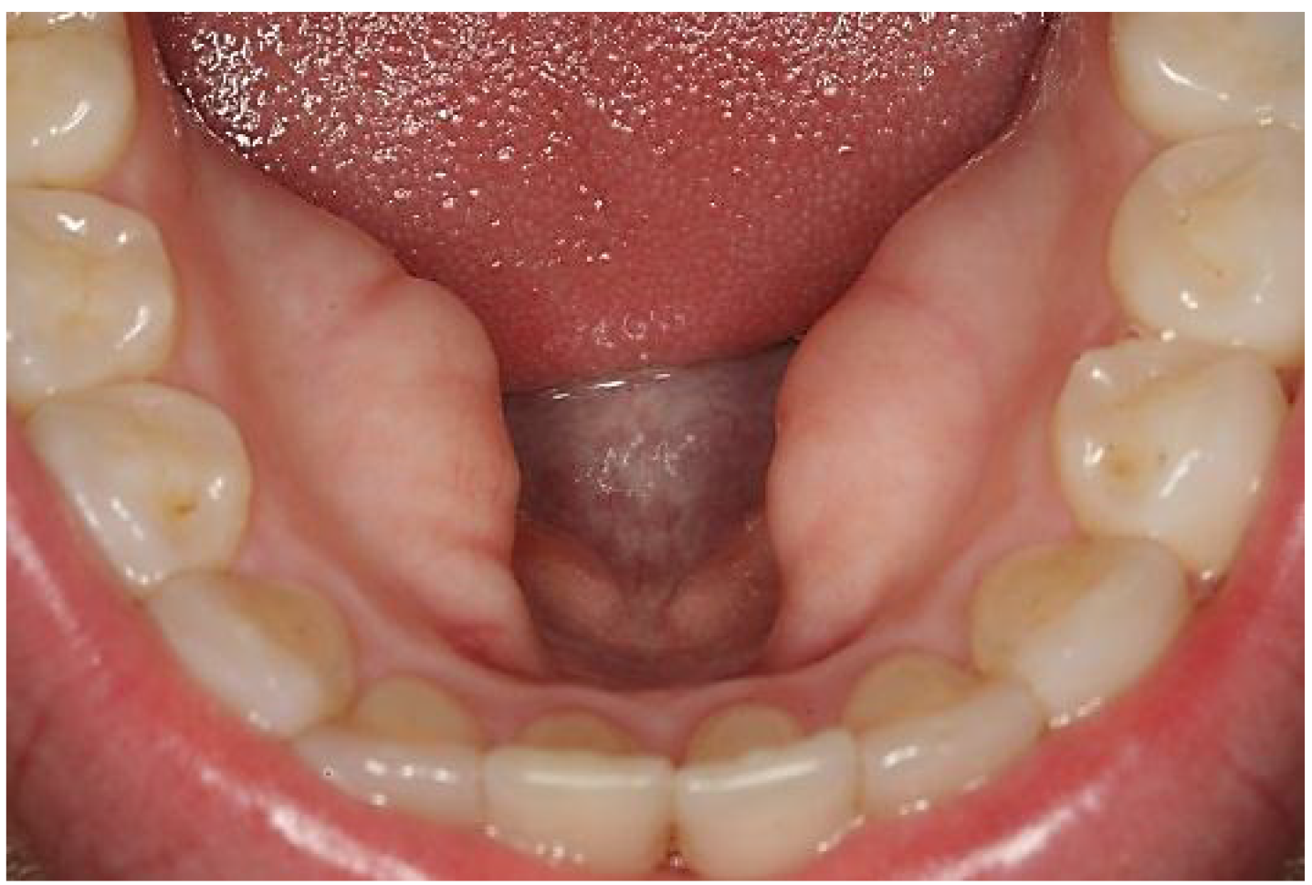 Normal Oral Cavity Findings And Variants Of Normal Intechopen