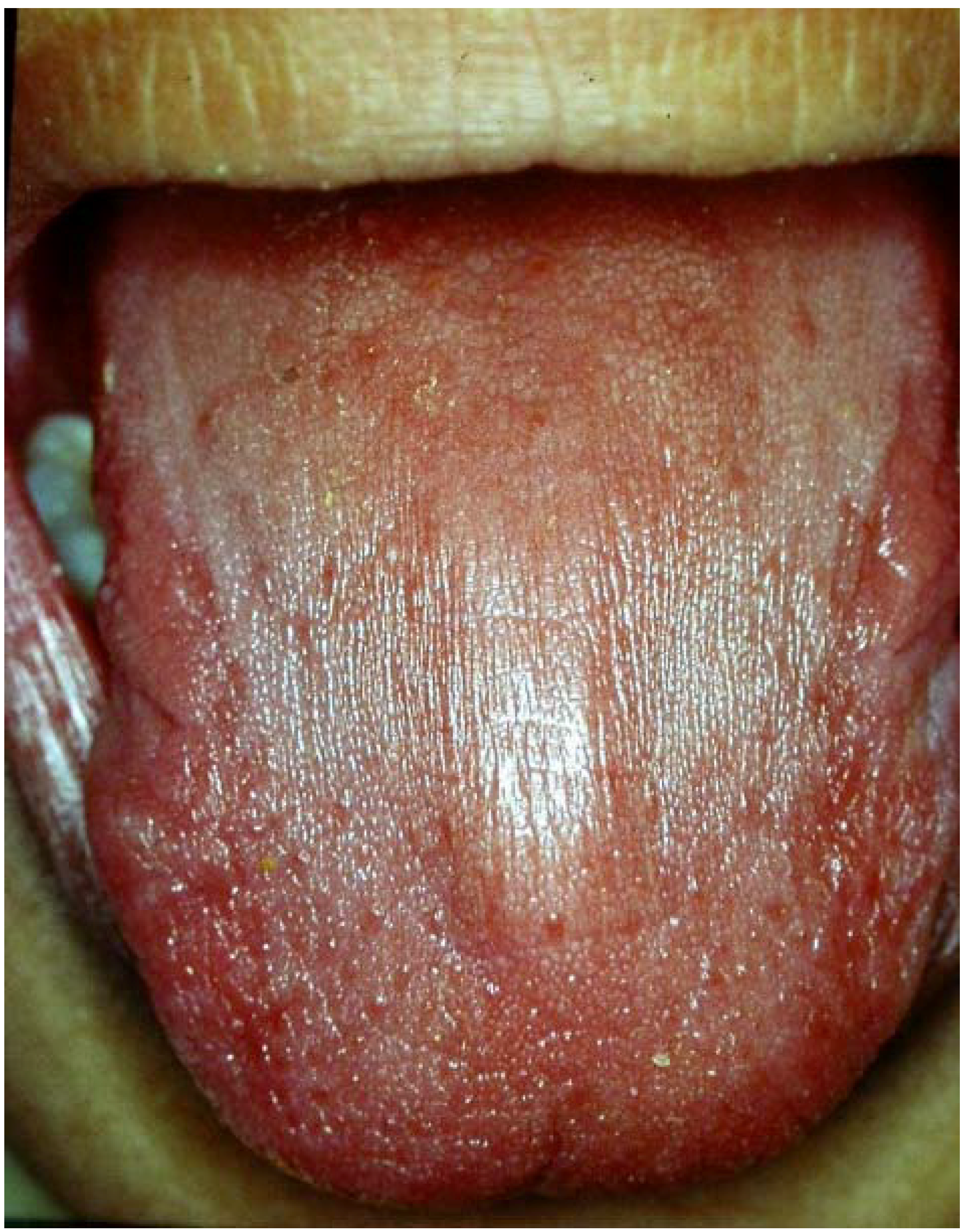 Treatment hsv 1 oral Antiviral therapy