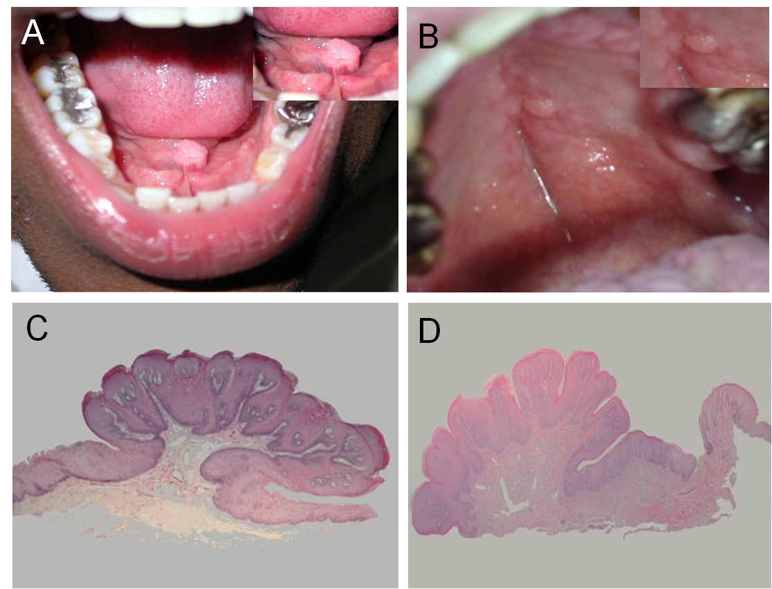 papilloma in mouth causes)