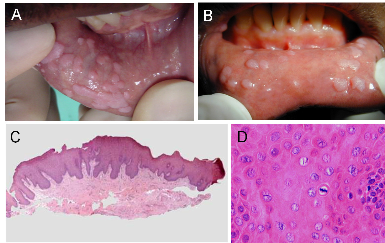 human papilloma in mouth