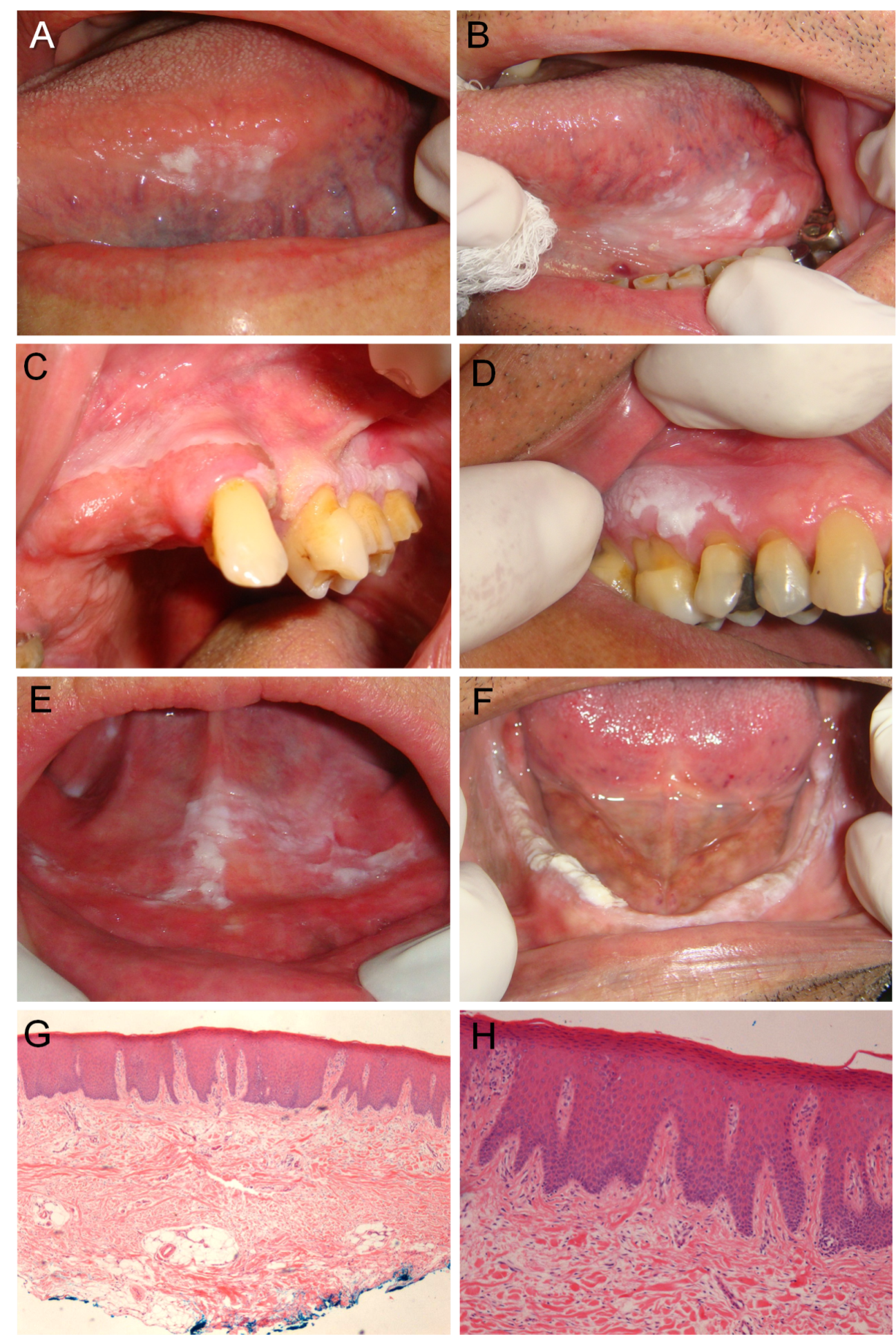 Removal of papilloma in mouth, Papillomavirus resultat frottis