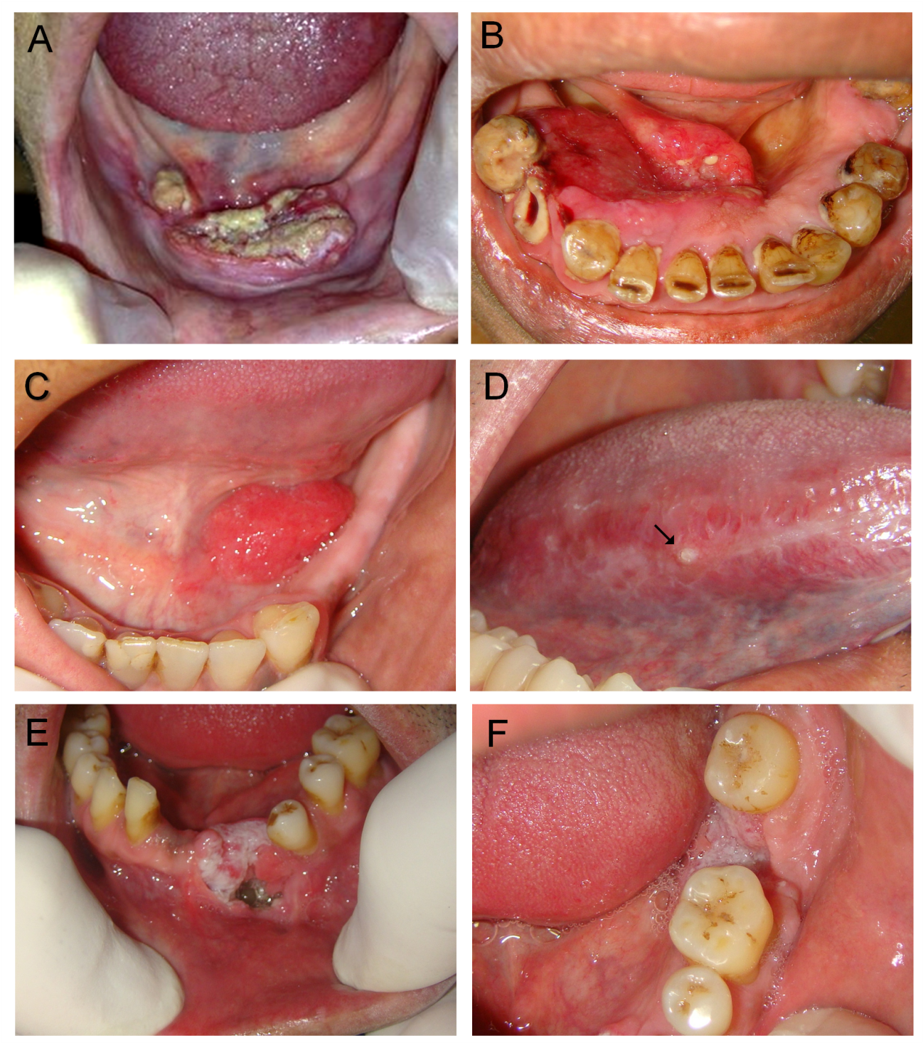 human papillomavirus hpv of the mouth)