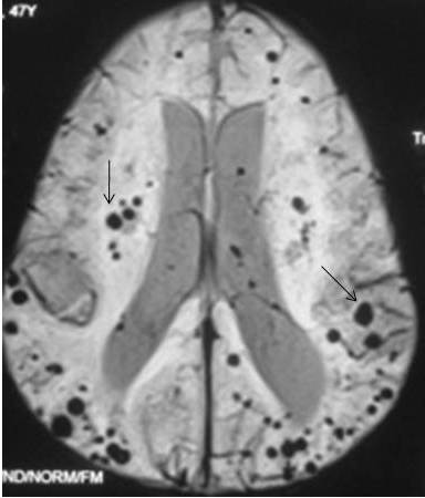 amyloid angiopathy cerebral hemorrhage intechopen figure