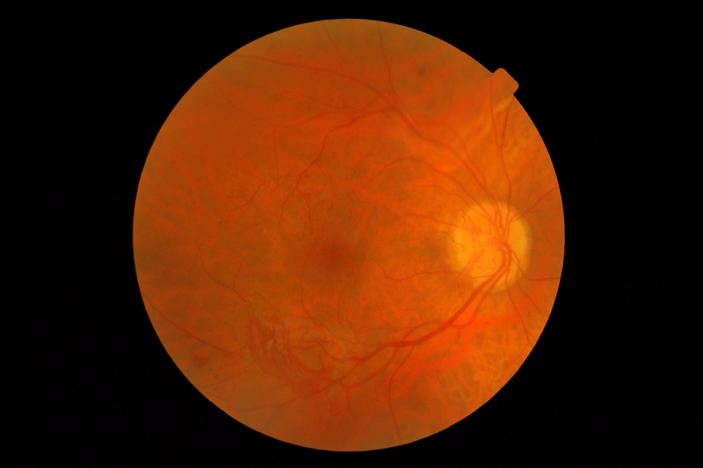 Diabetic Retinopathy – An Update on Pathophysiology, Classification