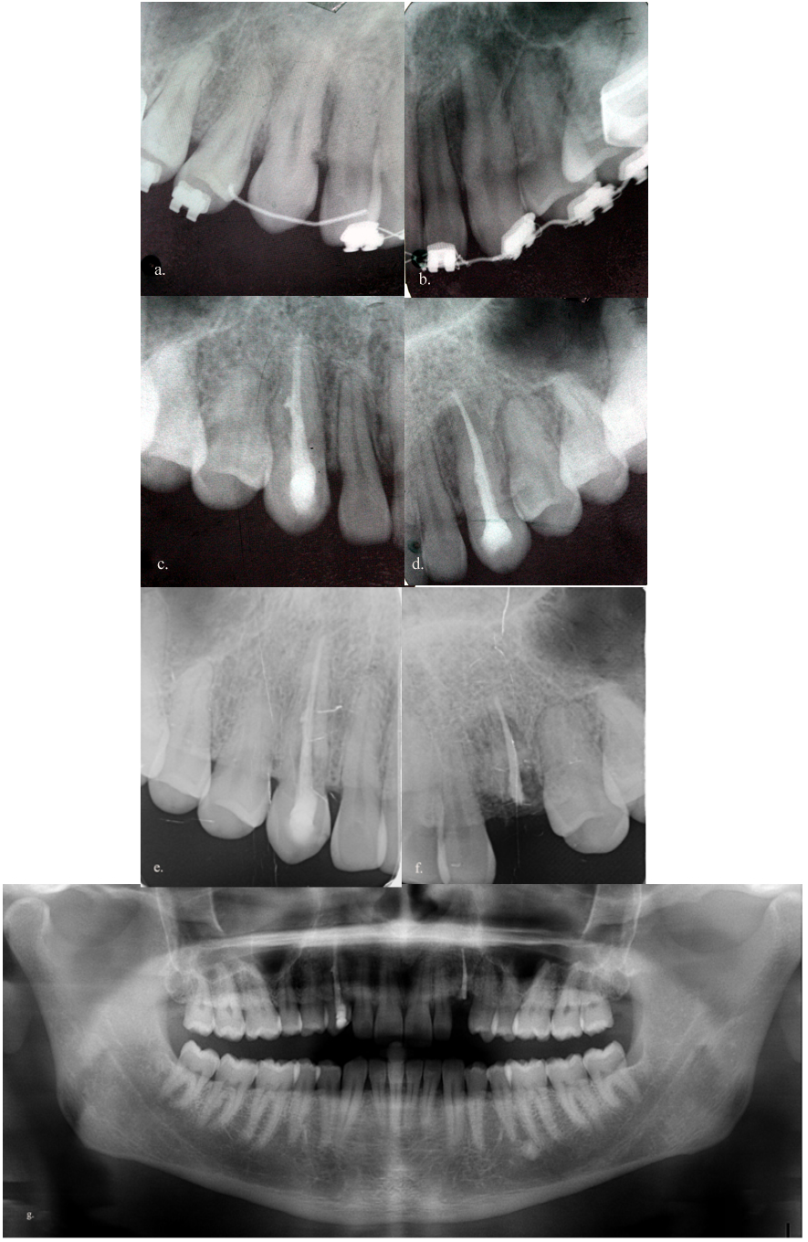 Clinical Consideration and Management of Impacted Maxillary Canine