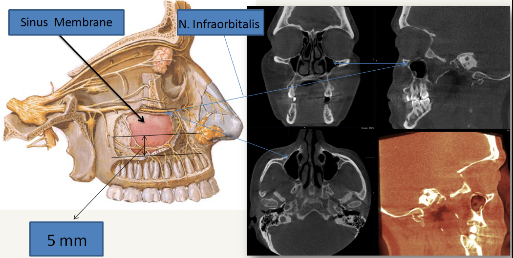 Treatment Approaches for Odontogenic Cysts of the Maxillary Sinus