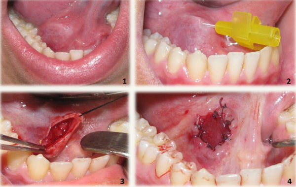Treatment Approaches for Odontogenic Cysts of the Maxillary Sinus IntechOpen