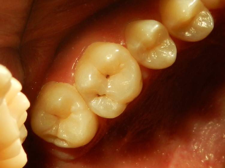 Are the Approximal Caries Lesions in Primary Teeth a Challenge to Deal  With? — A Critical Appraisal of Recent Evidences in This Field | IntechOpen