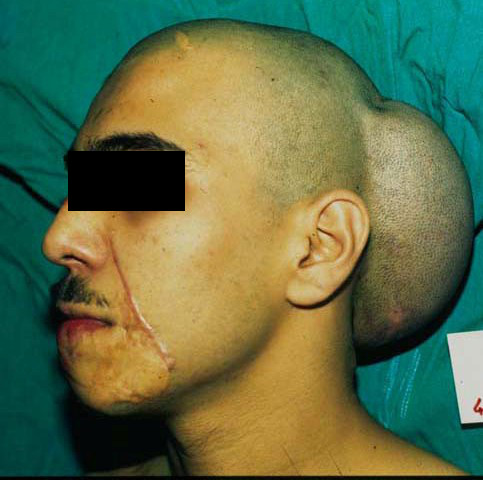 Reconstruction of Facial Hair Bearing Areas in the Male Patient | IntechOpen