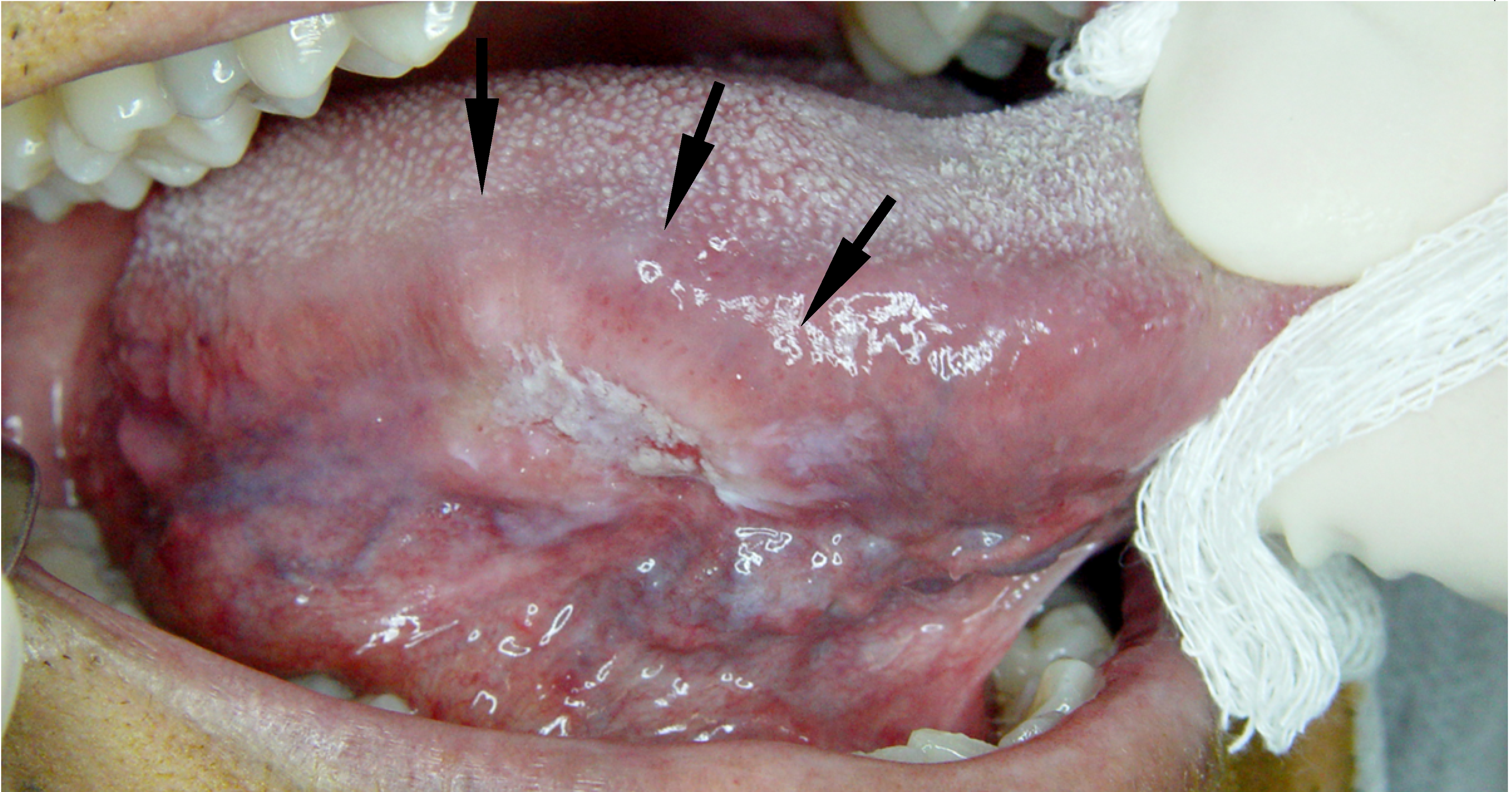 hpv base of tongue cancer prognosis