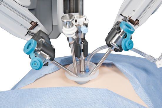 Robotic Surgery for ovarian cancer 