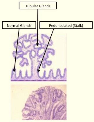 Villous papilloma definition, Histopathology Colon--Villous adenoma uterine cancer esmo