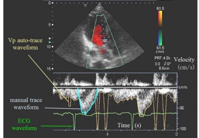 Application of DSP Concept for Ultrasound Doppler Image Processing ...