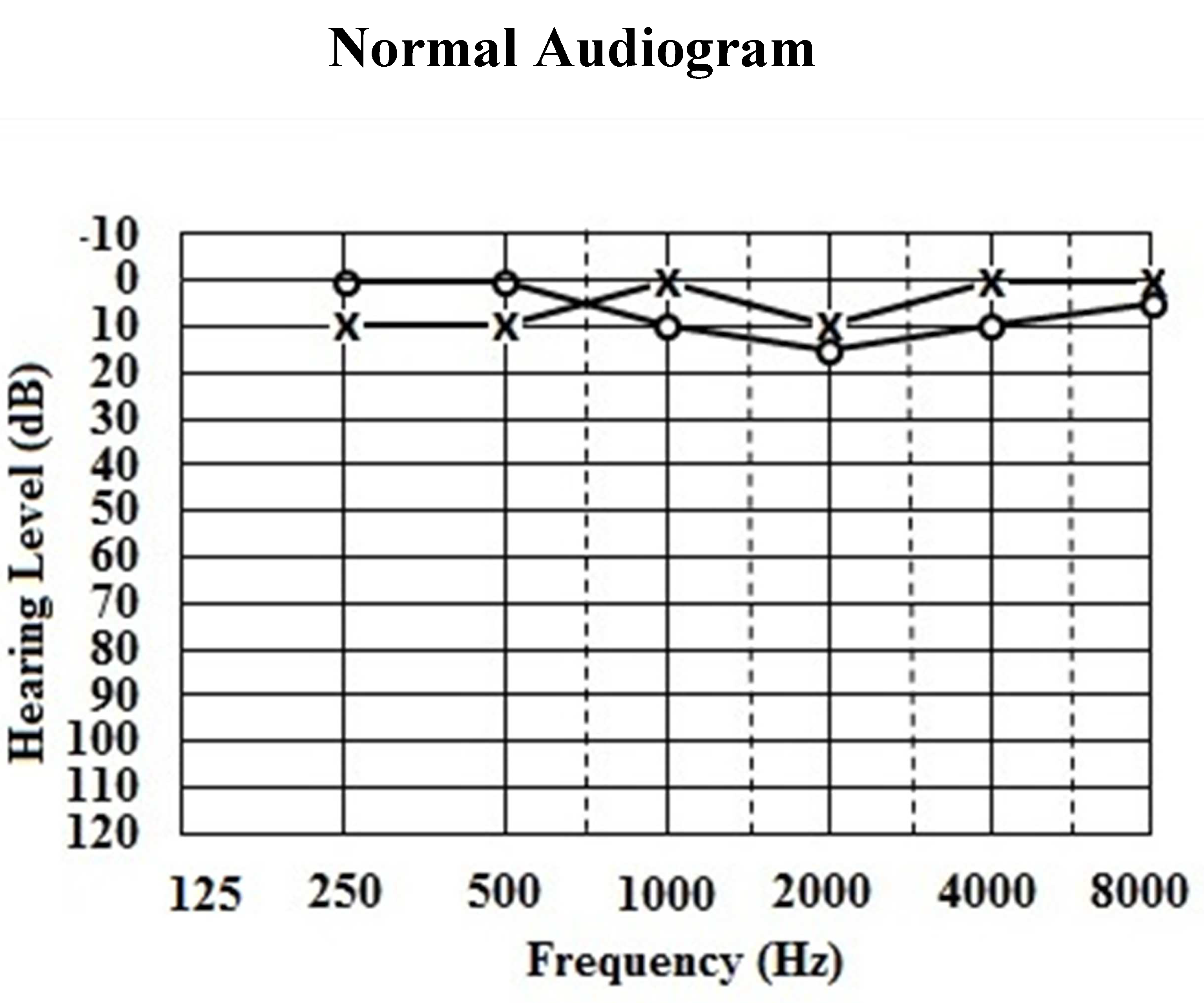 Degree Of Hearing Loss Chart
