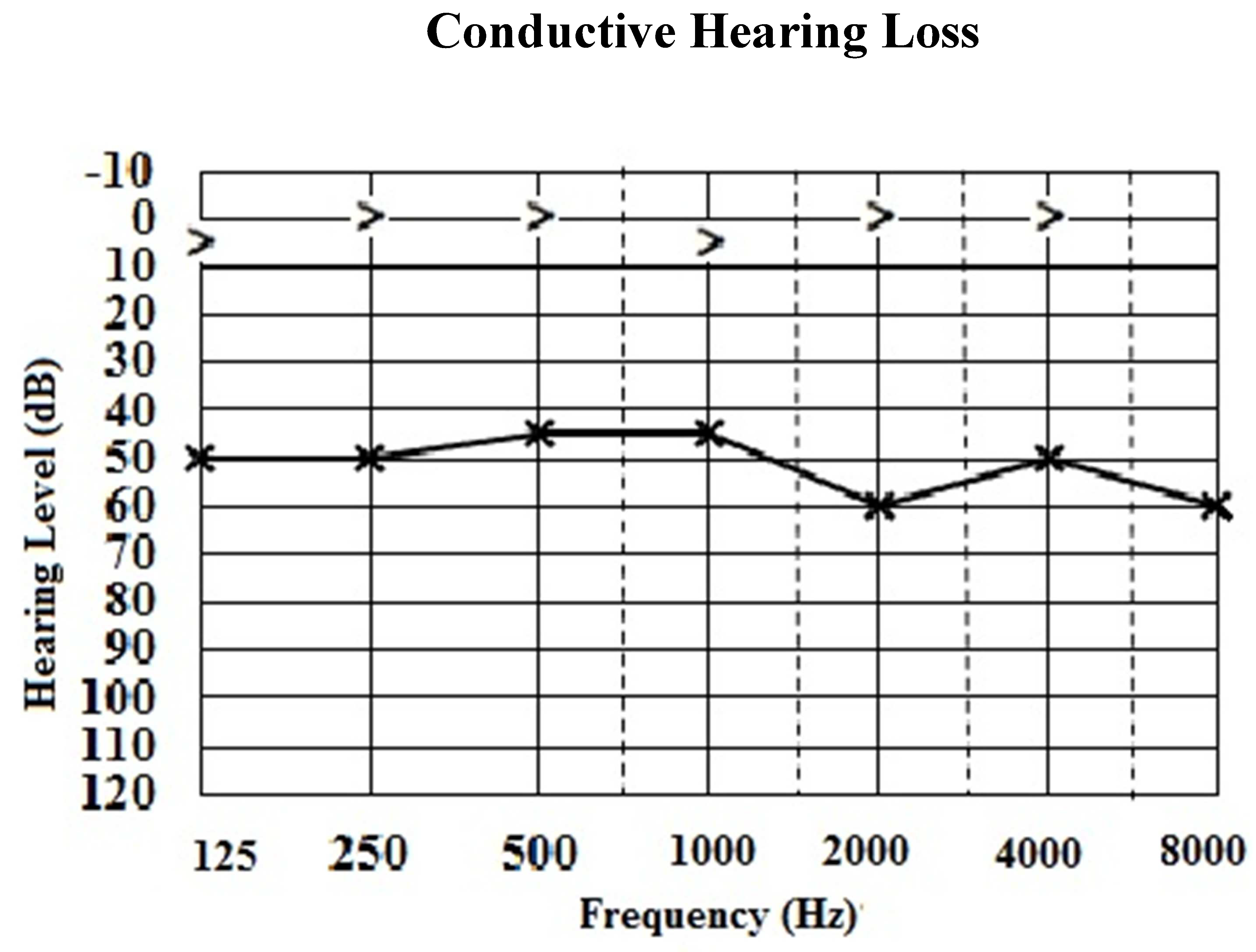 Classification of Hearing Loss | IntechOpen