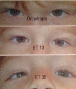 Principles of Strabismus Surgery for Common Horizontal and Vertical  Strabismus Types | IntechOpen