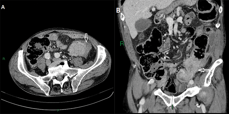 rectal cancer on ct scan)