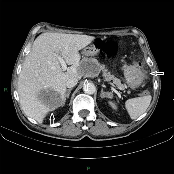 colorectal cancer on ct scan)