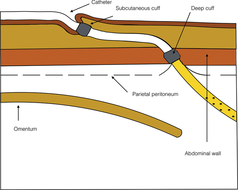 peritoneal-dialysis-catheters-intechopen