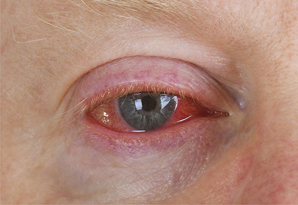 Overview of Common and Less Common Ocular Infections | IntechOpen