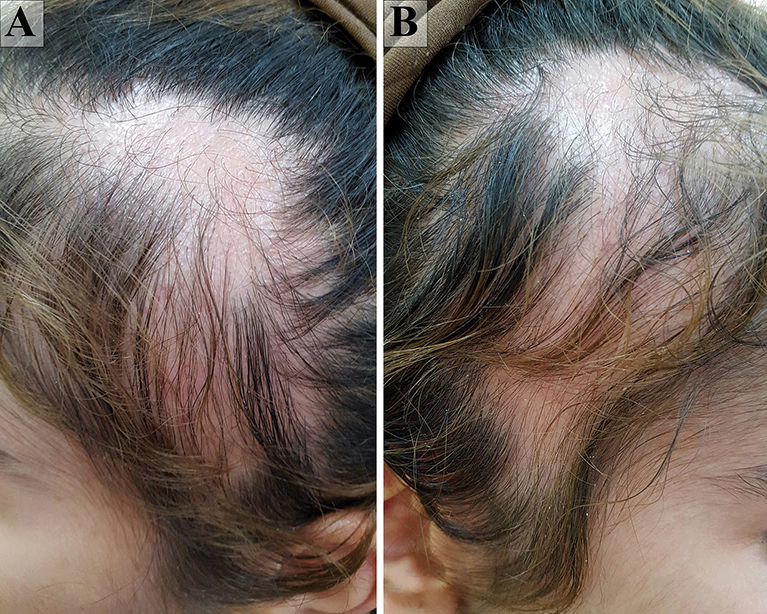 Trichotillomania and Traction Alopecia | IntechOpen