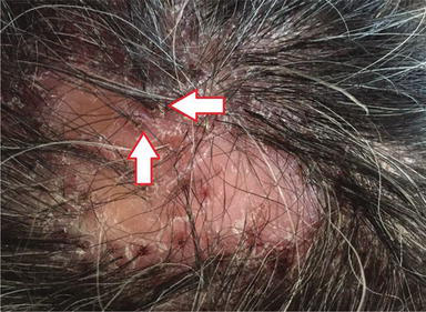 Infections, Infestations and Neoplasms of the Scalp | IntechOpen