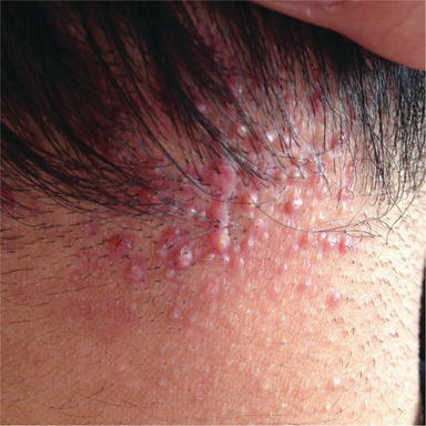 Infections, Infestations and Neoplasms of the Scalp | IntechOpen