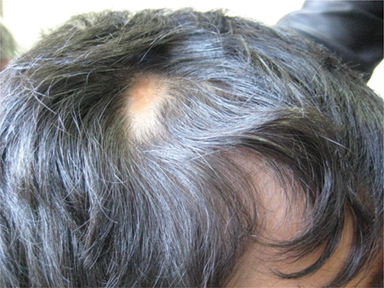 Hair Loss in Children, Etiologies, and Treatment | IntechOpen