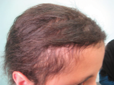 Hair Loss in Children, Etiologies, and Treatment | IntechOpen