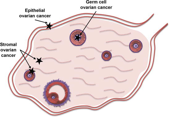 endocrine cancer of the ovary